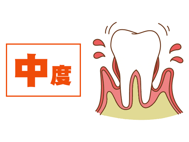 [進行度3] 歯がぐらつく