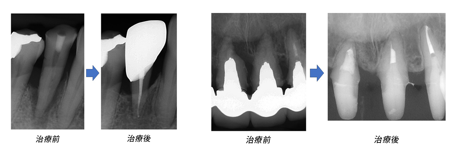 根管治療1