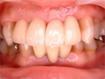 インプラント症例 術後