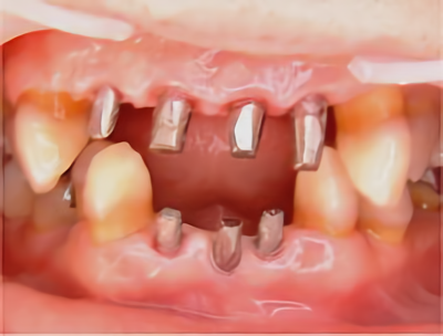 インプラント症例 術中