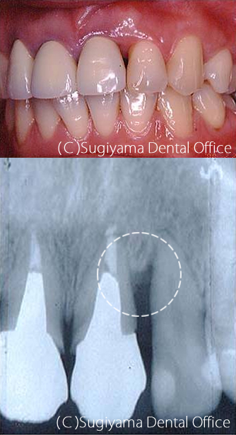 歯周治療症例2 術後