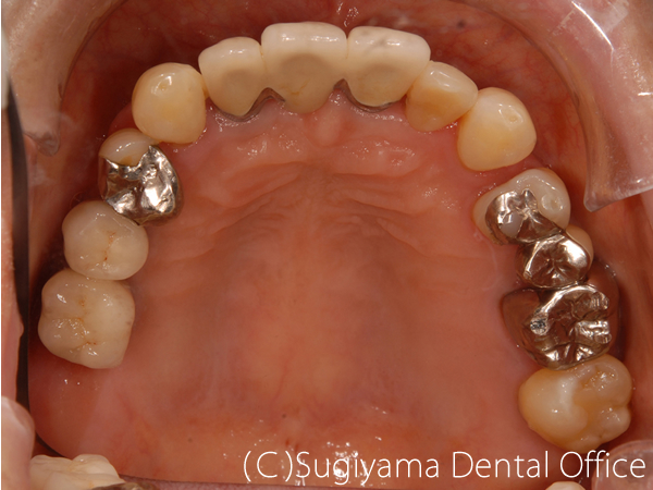 歯周治療症例3 術後