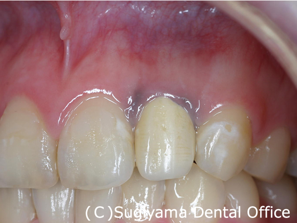 歯周治療症例4 術前