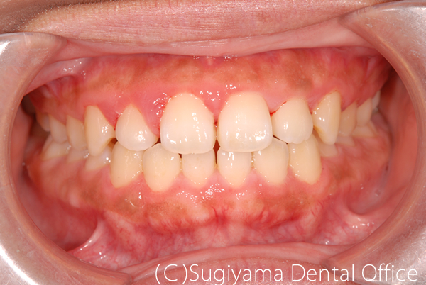 歯周治療症例1 術前