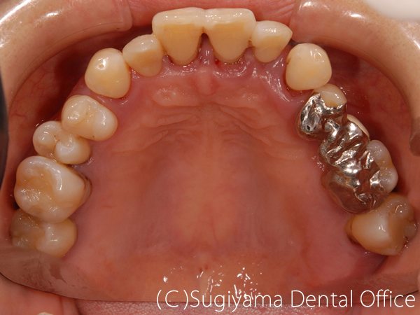 歯周治療症例3 術前
