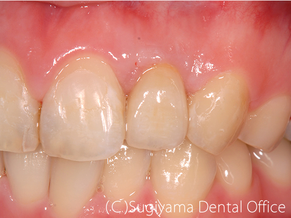 歯周治療症例4 術後