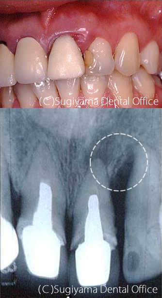 歯周治療症例2 術前