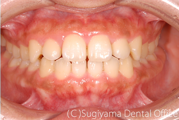 歯周治療症例1 術後