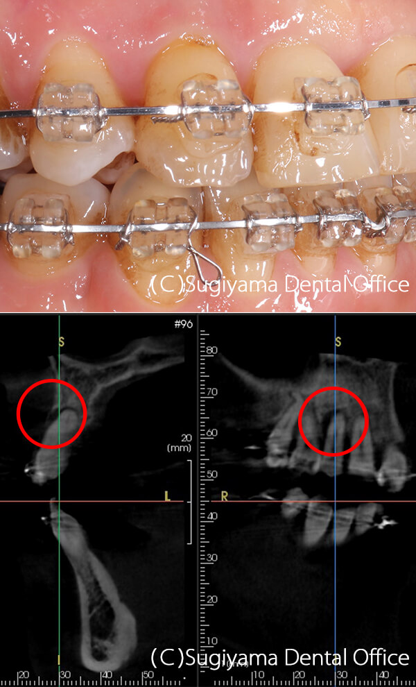 歯周治療症例4 術前
