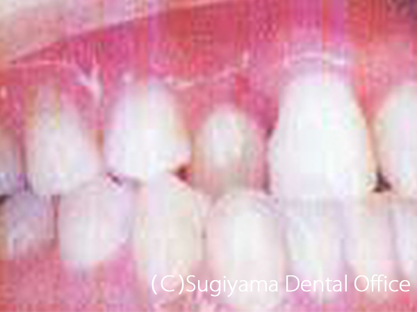 歯周治療症例5 術前