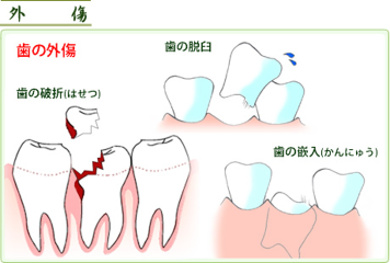 歯の外傷（ケガ）について - 歯合わせブログ - 仙台市青葉区