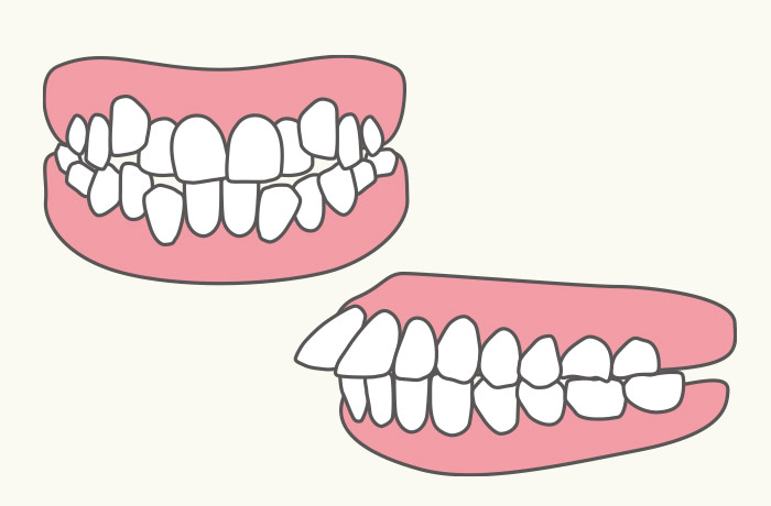 重度の歯列不正の場合