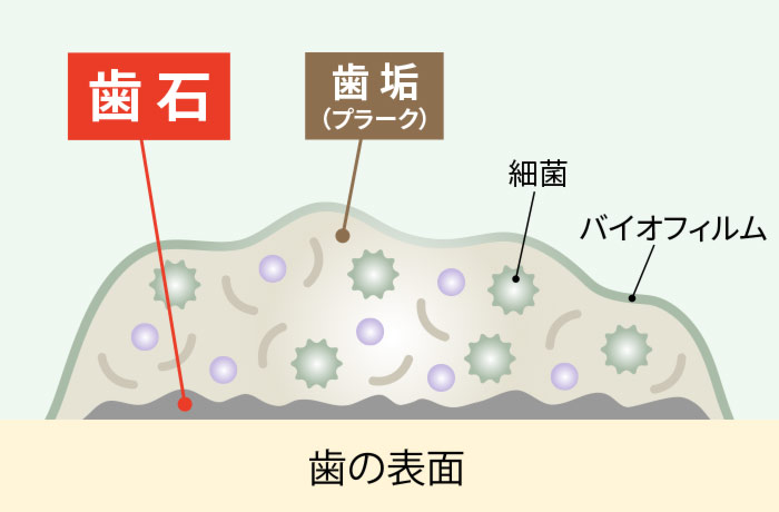 歯石とは？歯垢との違いを知ろう