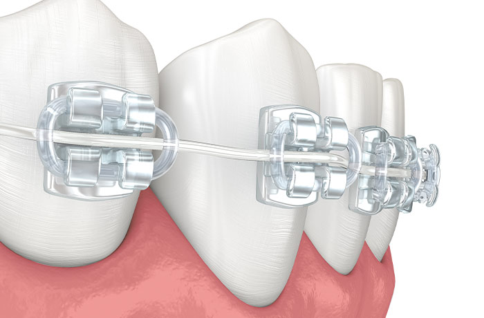 セラミックのブラケット