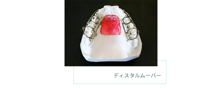 仙台 - ぬかつか矯正歯科クリニック - ディスタルムーバー