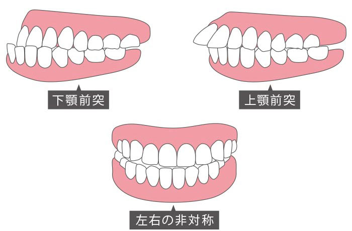 将来オペが必要になりやすい歯並び