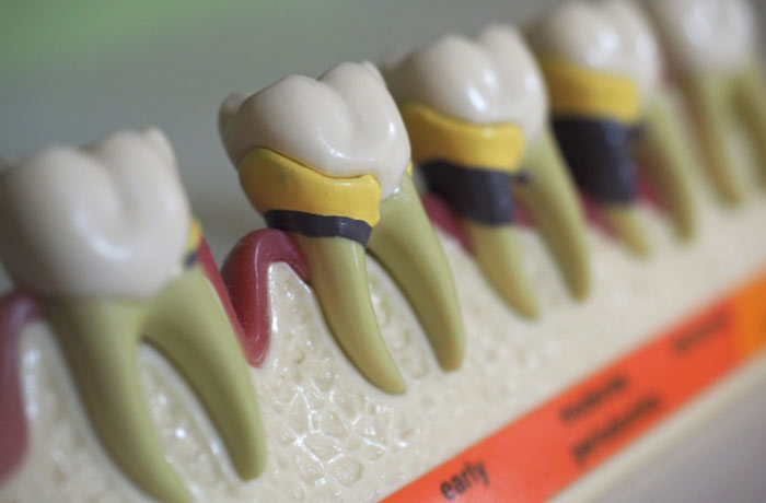 歯肉炎、歯周病が進みやすくなる