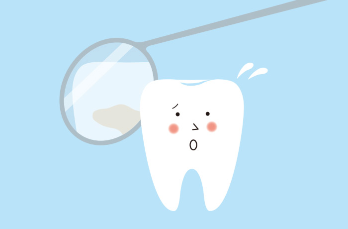 歯石ができる原因とつきやすい場所