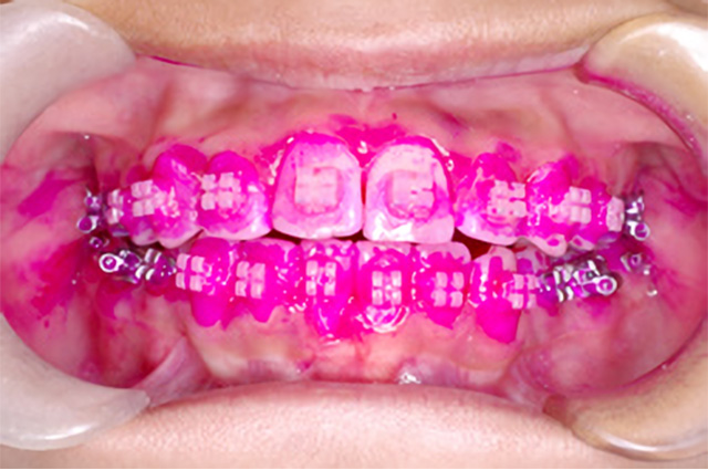 仙台 - ぬかつか矯正歯科クリニック - 予防処置 - 矯正治療中の歯の汚れを染め出した状態