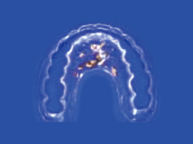 仙台 - ぬかつか矯正歯科クリニック - 矯正治療の流れ - 第 II 期開始→後戻り防止の保定装置（リテーナー）