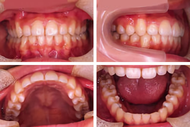 仙台 - ぬかつか矯正歯科クリニック - 矯正治療の流れ - 第 II 期終了 保定開始
