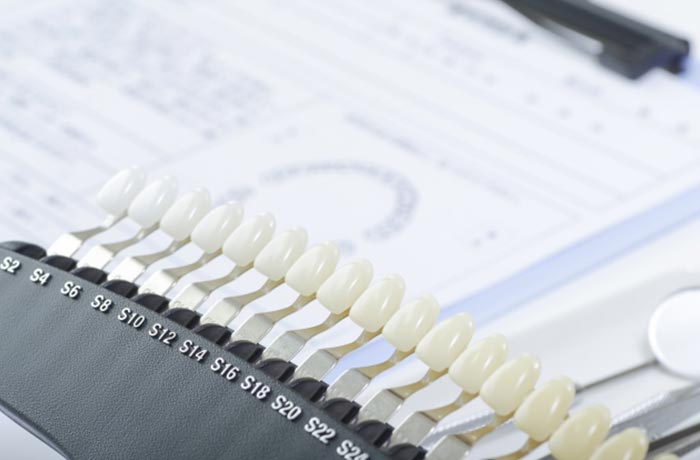 変色はホワイトニングや補綴治療が必要なことがある