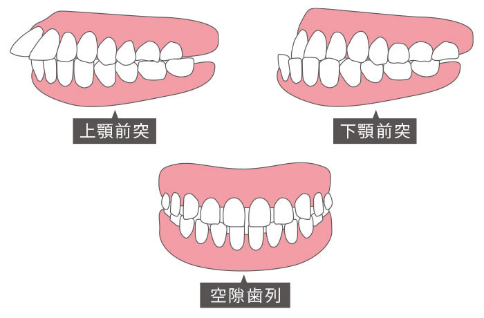 こんな歯並びは発音に影響が出やすい