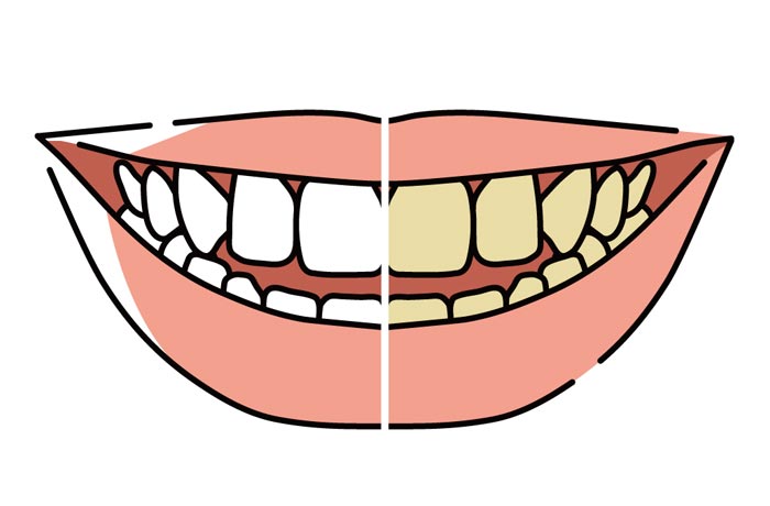歯の表面につく「着色」