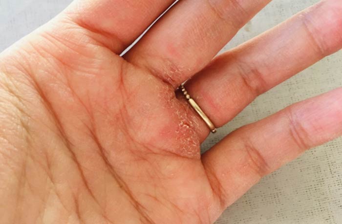 金属アレルギーによる手荒れの症状