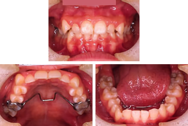 仙台 - ぬかつか矯正歯科クリニック - 矯正治療の流れ - 第 II 期開始