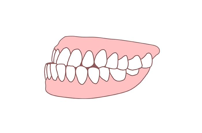 受け口の自然治癒は期待できない