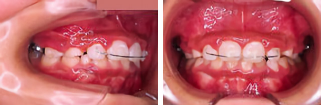 仙台 - ぬかつか矯正歯科クリニック - 矯正治療の流れ - 反対咬合の直った時