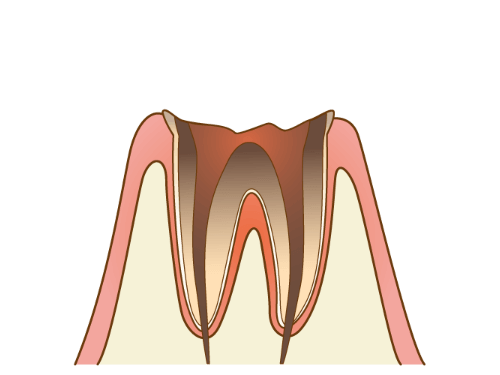 C4（末期の虫歯）