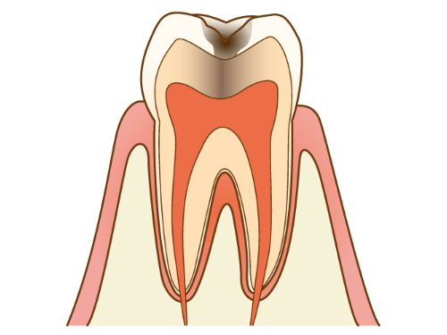 C2（中期の虫歯）
