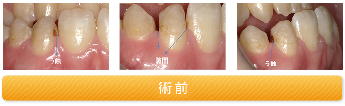 両隣接面にう蝕があり、隣在歯との間に隙間がある症例 術前