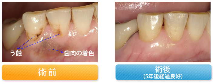 う蝕と歯肉の変色を修復した症例