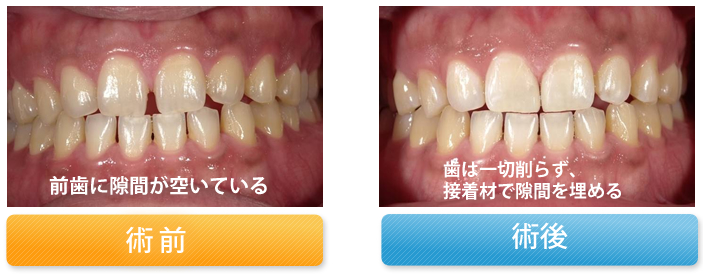 前歯の隙間を修復した症例