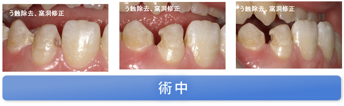 両隣接面にう蝕があり、隣在歯との間に隙間がある症例 術中