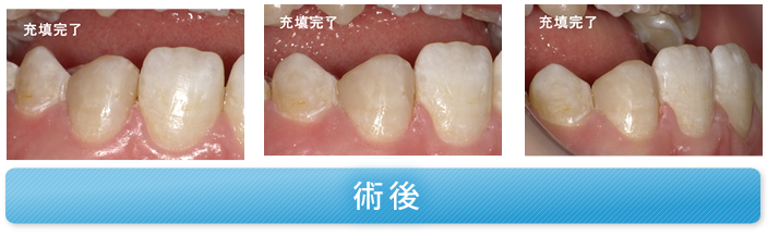 両隣接面にう蝕があり、隣在歯との間に隙間がある症例 術後