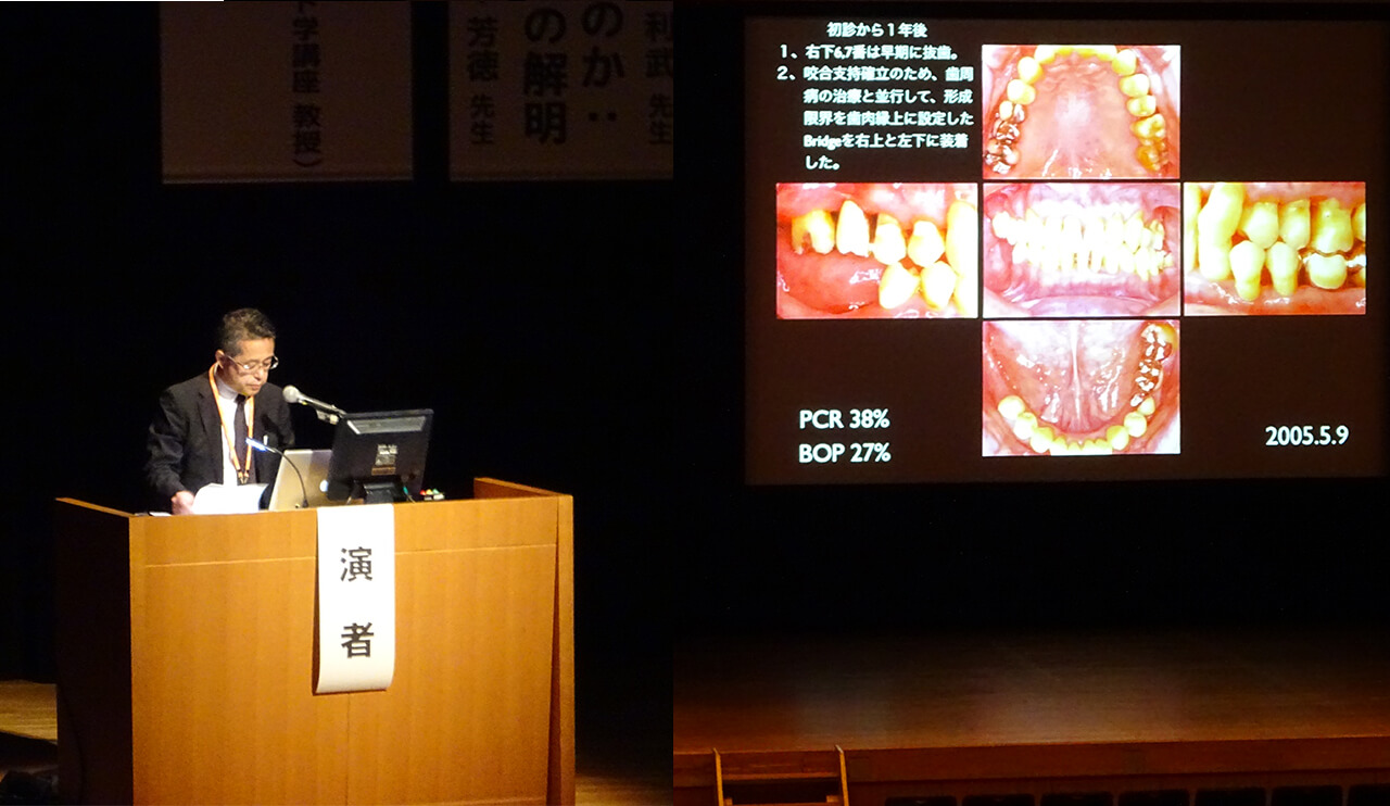 第３５回日本口腔インプラント学会東北・北海道支部学術大会 演題「重度歯周病患者にインプラント治療を応用し １０ 年経過した 1 症例」