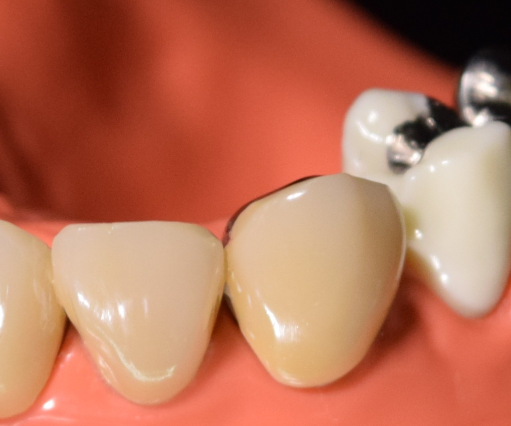 歯の治療に使用する材料について