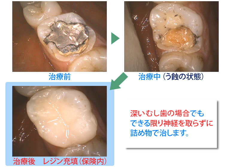 【治療の流れ】深いむし歯の場合でもできる限り神経を取らずに詰め物で治します。