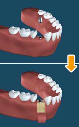 3.二次手術(新しい歯を装着する準備の手術)