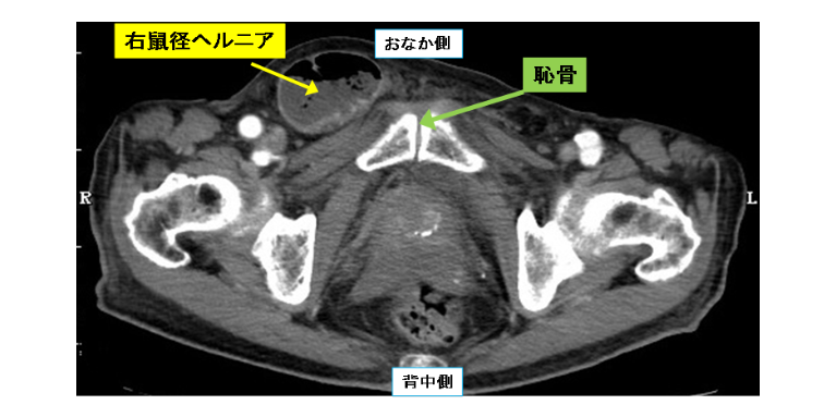 鼠経ヘルニア