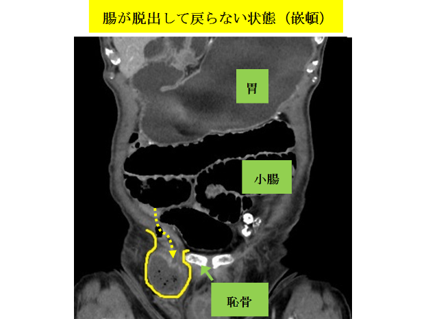 鼠経ヘルニア