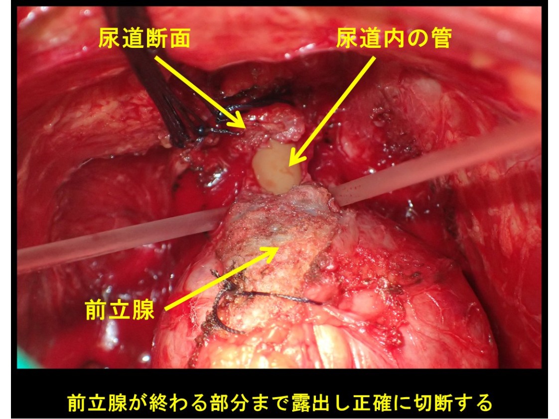 前立腺手術4