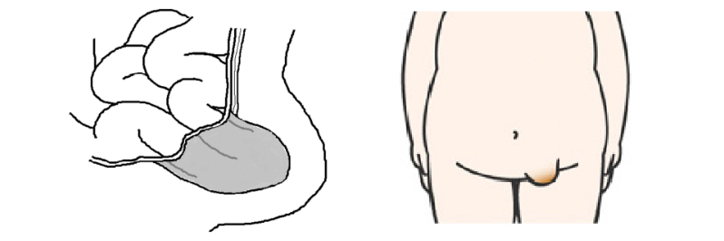 鼠経ヘルニア