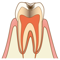 むし歯（C2）の歯の断面図