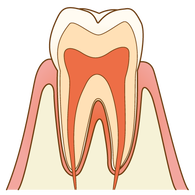 むし歯（C0）の歯の断面図