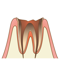 むし歯（C4）の歯の断面図